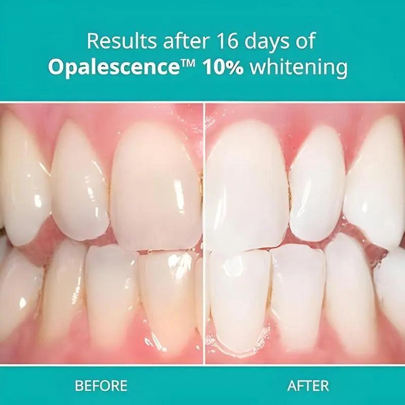 Opalescence 10% Teeth Whitening Kit - Gel Syringes Refills - Low Sensitivity - Moon White