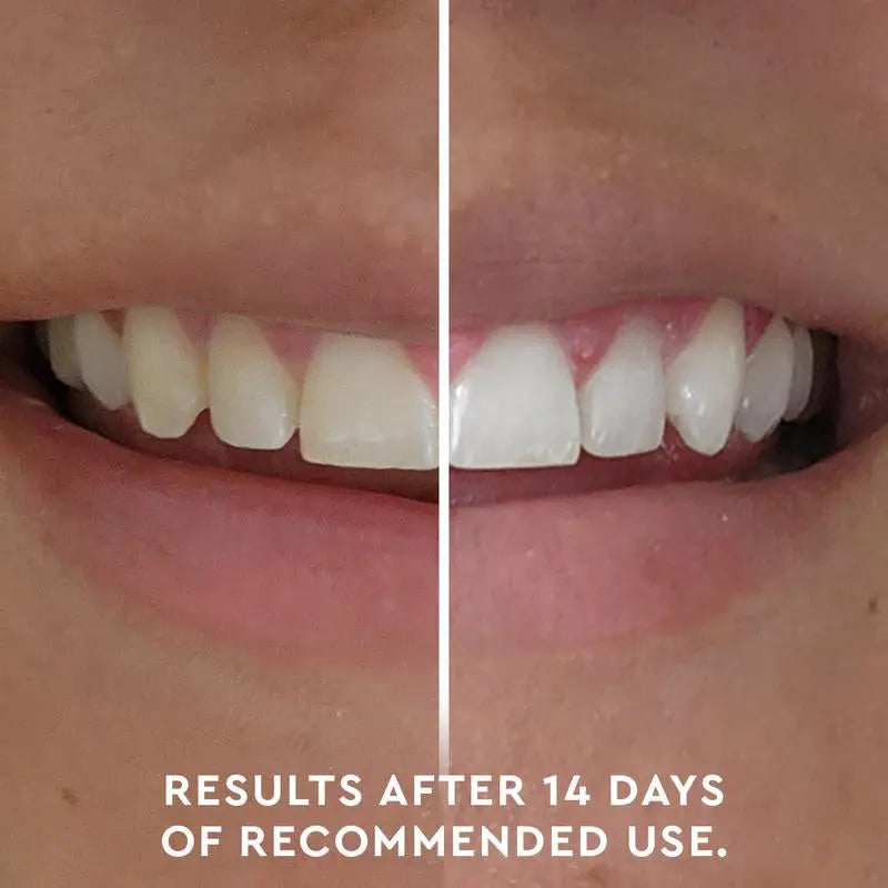 MOON Professional Teeth Whitening Kit with LED Light, Wireless 5-Minute Treatment - Moon White